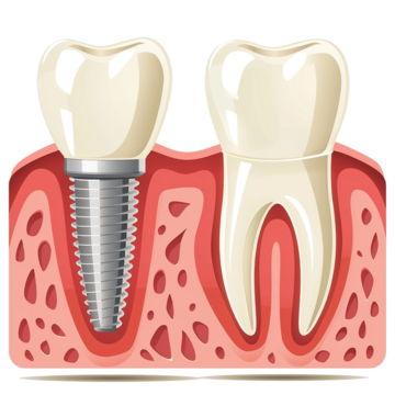 Bước 4: Tiến hành cấy ghép Implant