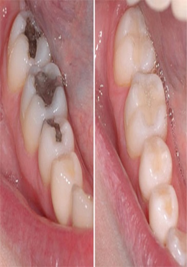 Trước điều trị